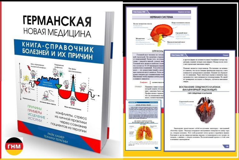 Как лечить мигрень