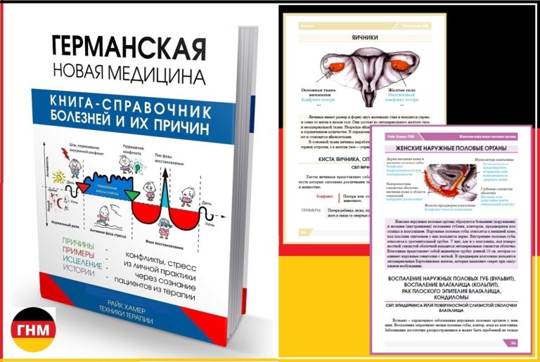 Киста маточной трубы